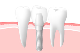 インプラント治療をお考えの方へ